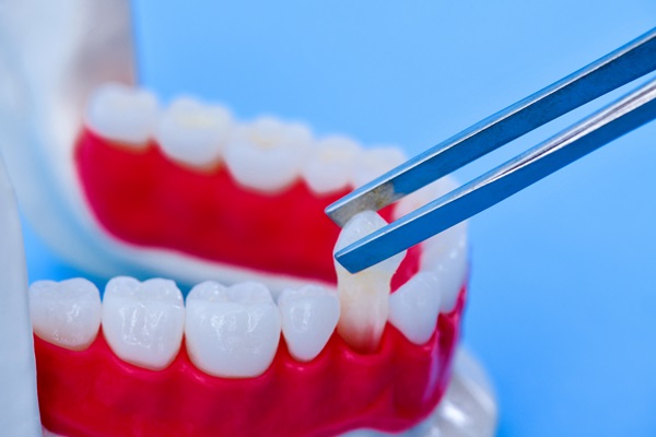 Understanding The Procedure For Dental Implants